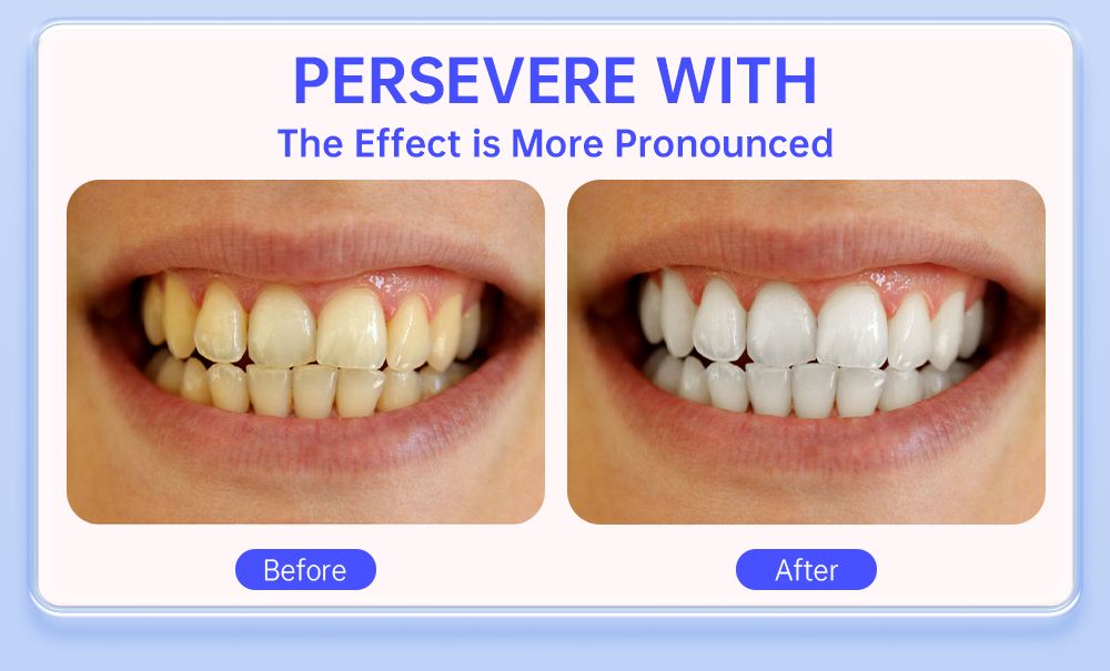 roaadent Whitening Kit – LED Bleaching Set